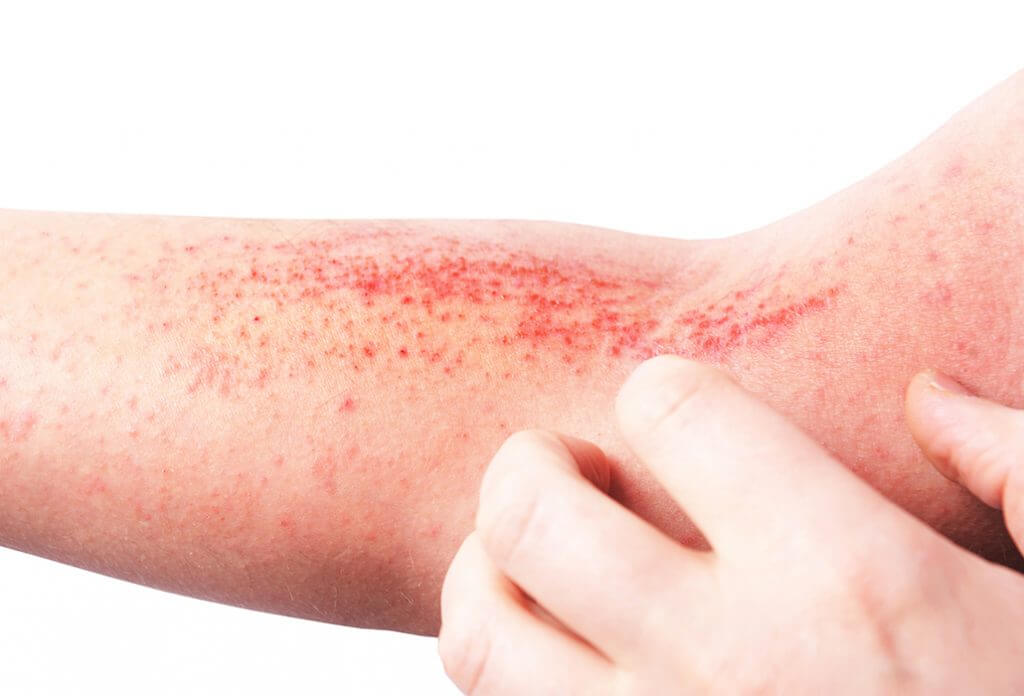 Atopic Dermatitis