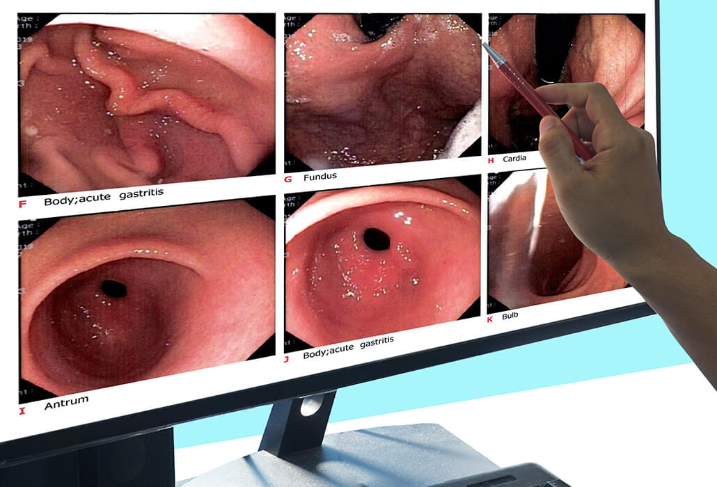 Close up Report of Gastrointestinal Endoscopy