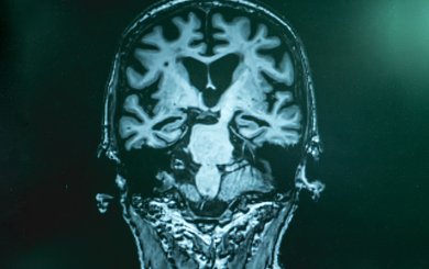 alzheimer's disease with MRI