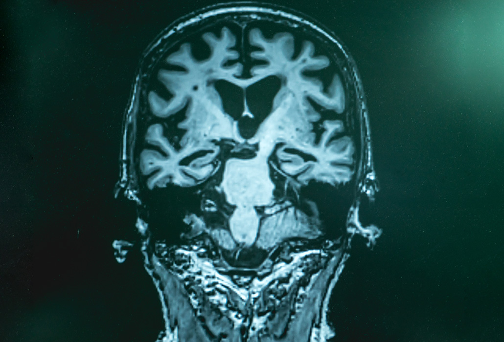 alzheimer's disease with MRI