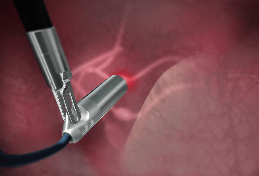 Lightpoint Medical, miniaturised cancer detection tools for robot-assisted surgery