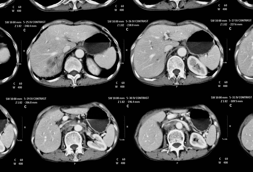 cholangiocarcinoma