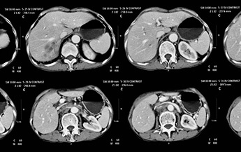 Ct,Scan,Of,Abdominal,Pain,,Case,Of,Cholangiocarcinoma,,